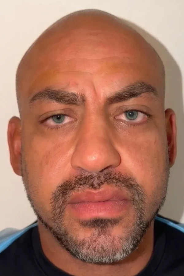 Resultat keratopigmentation apres