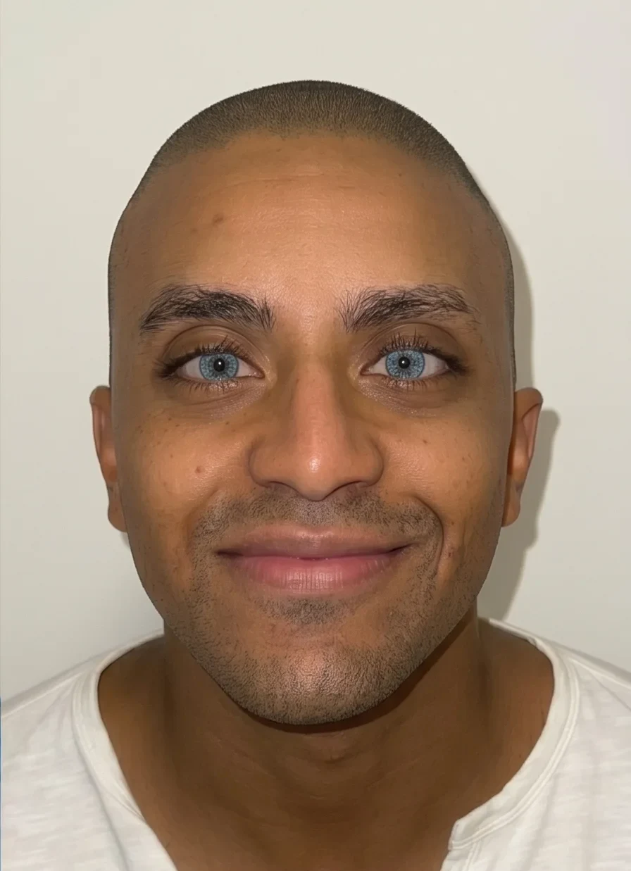 Kératopigmentation FLAAK - résultat après intervention, patient 09