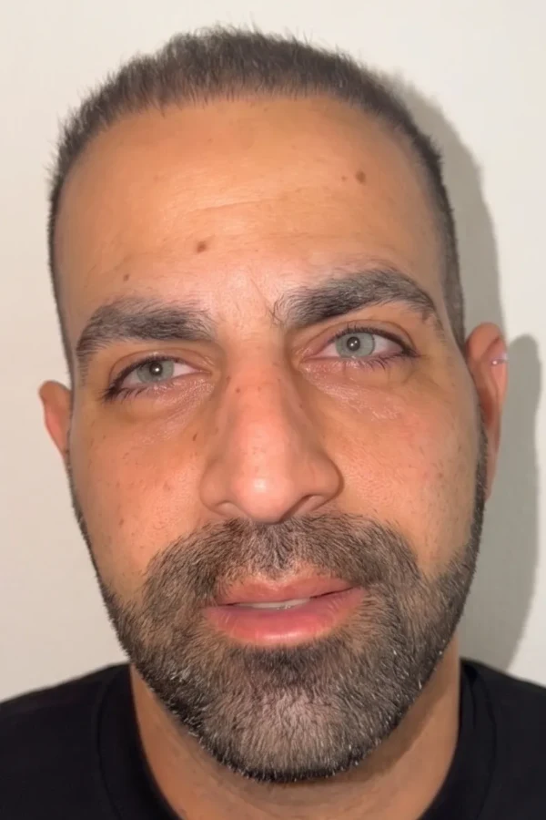 Kératopigmentation FLAAK - résultat après intervention, patient 10