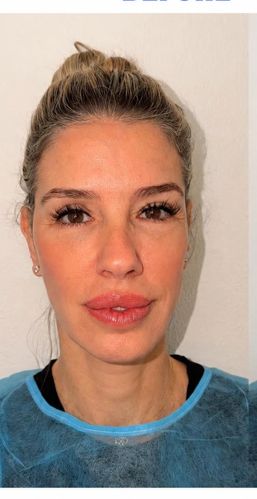 Resultat keratopigmentation avant