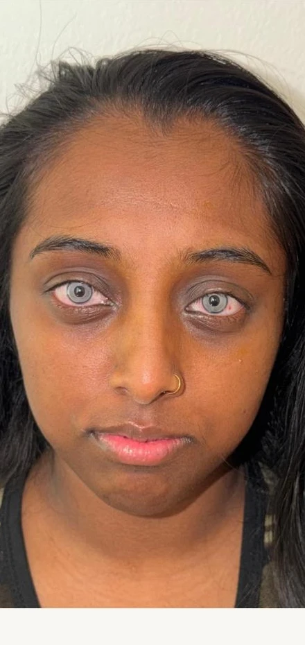 Kératopigmentation FLAAK - résultat après intervention, patient 20