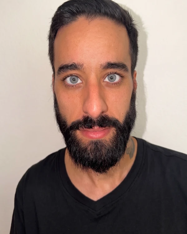 Resultat keratopigmentation apres