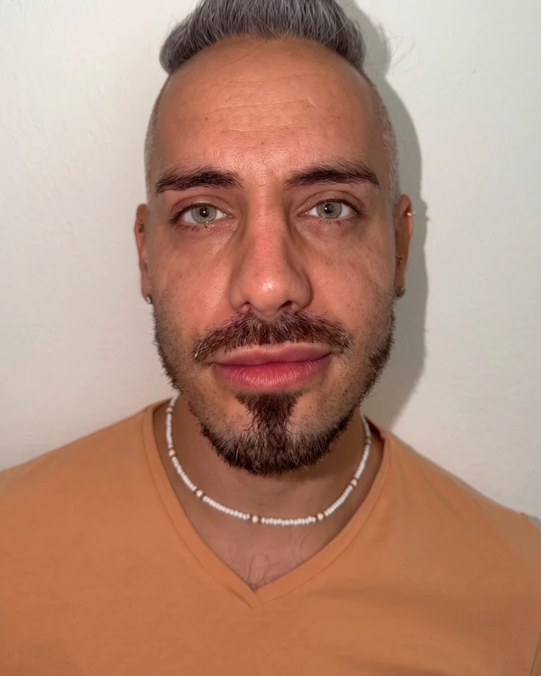 Kératopigmentation FLAAK - résultat après intervention, patient 22